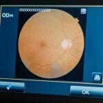 Que Es La Presion Intraocular